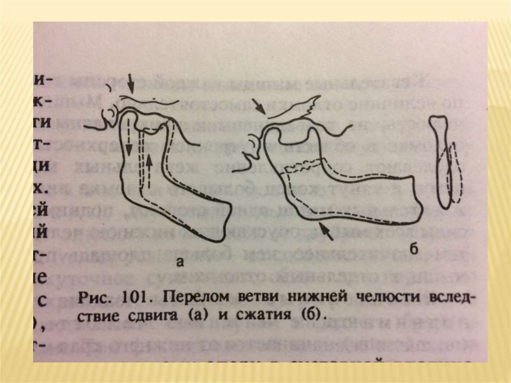 На нижней ветви. Перелом ветви нижней челюсти. Перелом ветви нижней челюсти слева. Раны презентация травматология. Описание перелома ветви челюсти.