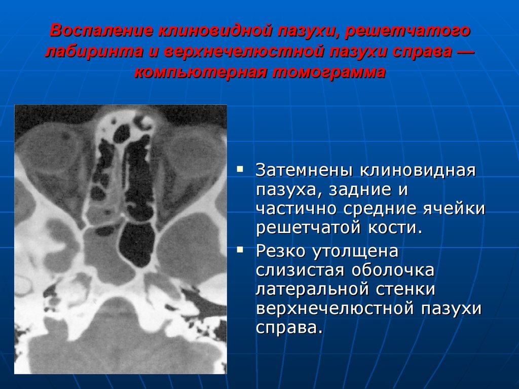 Гиперплазия слизистой верхнечелюстной. Пазухи клиновидной кости на кт. Анатомия клеток решетчатого Лабиринта на кт. Воспаление клиновидной пазухи. Утолщение слизистой оболочки клиновидной пазухи.