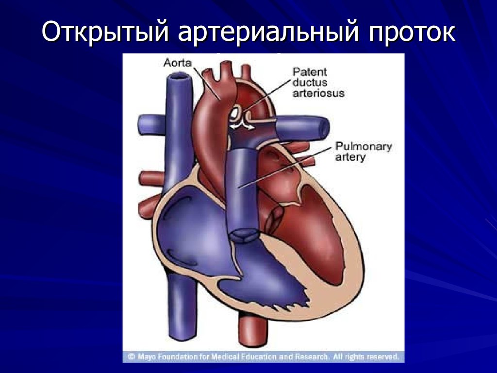 Оап у новорожденных. Врожденный порок сердца открытый артериальный проток. Врожденные пороки сердца ОАП. ВПС: - открытый Баталов проток. Открытый боталлов проток.