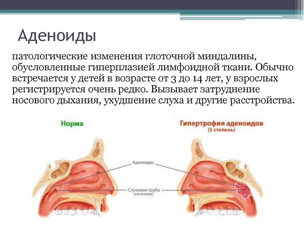 Чем лечить аденоиды. Гипертрофия аденоидов симптомы. Функции аденоиды анатомия. Аденоиды это разрастание лимфоидной ткани. Патогенез гипертрофии аденоидов.