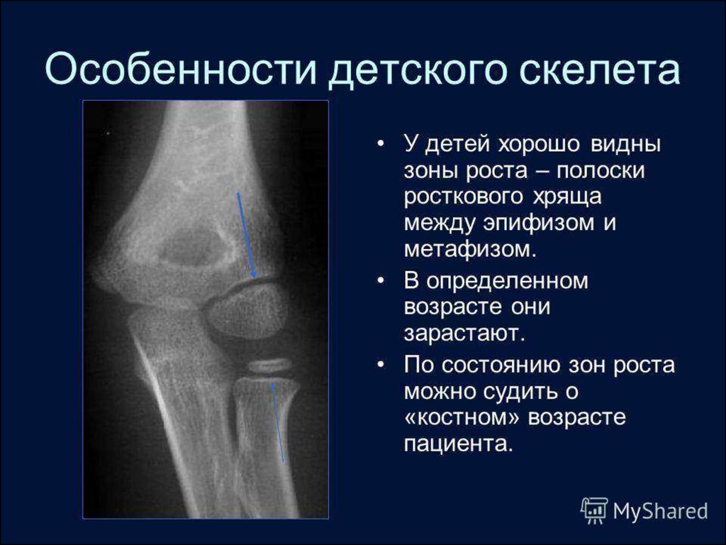 Зоны кости. Зоны роста большеберцовой кости на рентгене. Зона роста эпифиза бедренной кости. Зона роста локтевой кости на рентгене. Зоны роста плечевой кости.