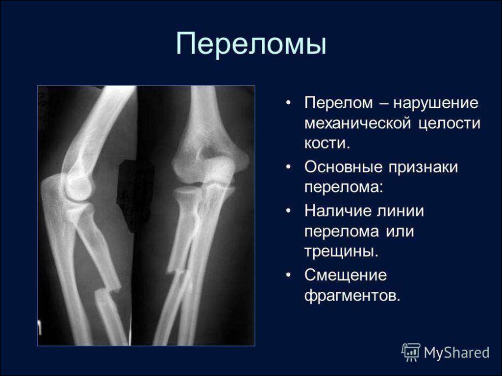 Трещина это перелом. Продольный перелом лучевой кости. Рентген признаки перелома кости. Переломы костей рентгенограммы. Симптом перелома кости на рентгене.