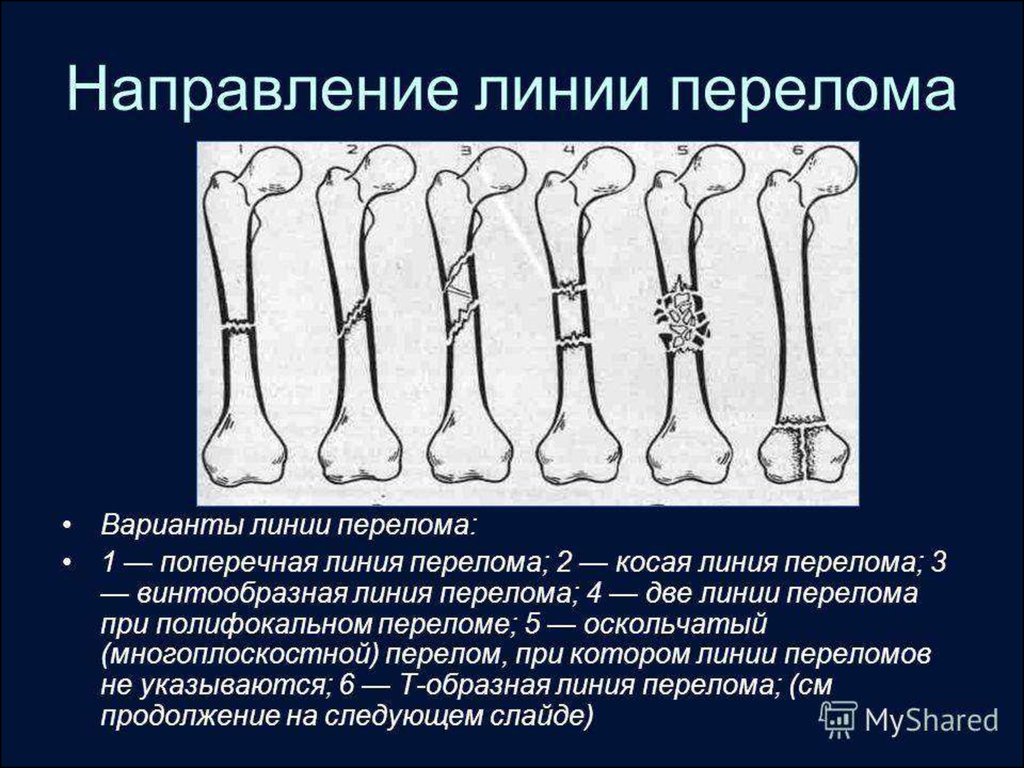 Перелом кости называется. Переломы поперечные косые продольные. Схема переломов трубчатых костей. Классификация переломов по линии излома. Направление линии перелома.