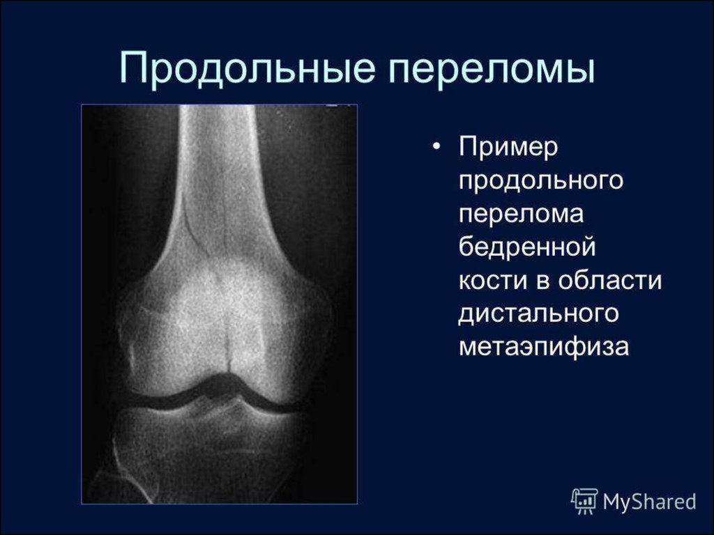 Дистальные переломы бедренной кости. Дистальный метаэпифиз большеберцовой кости. Костная киста дистального метаэпифиза бедренной кости. Перелом эпифиза бедренной кости. Перелом диафиза бедренной кости классификация.