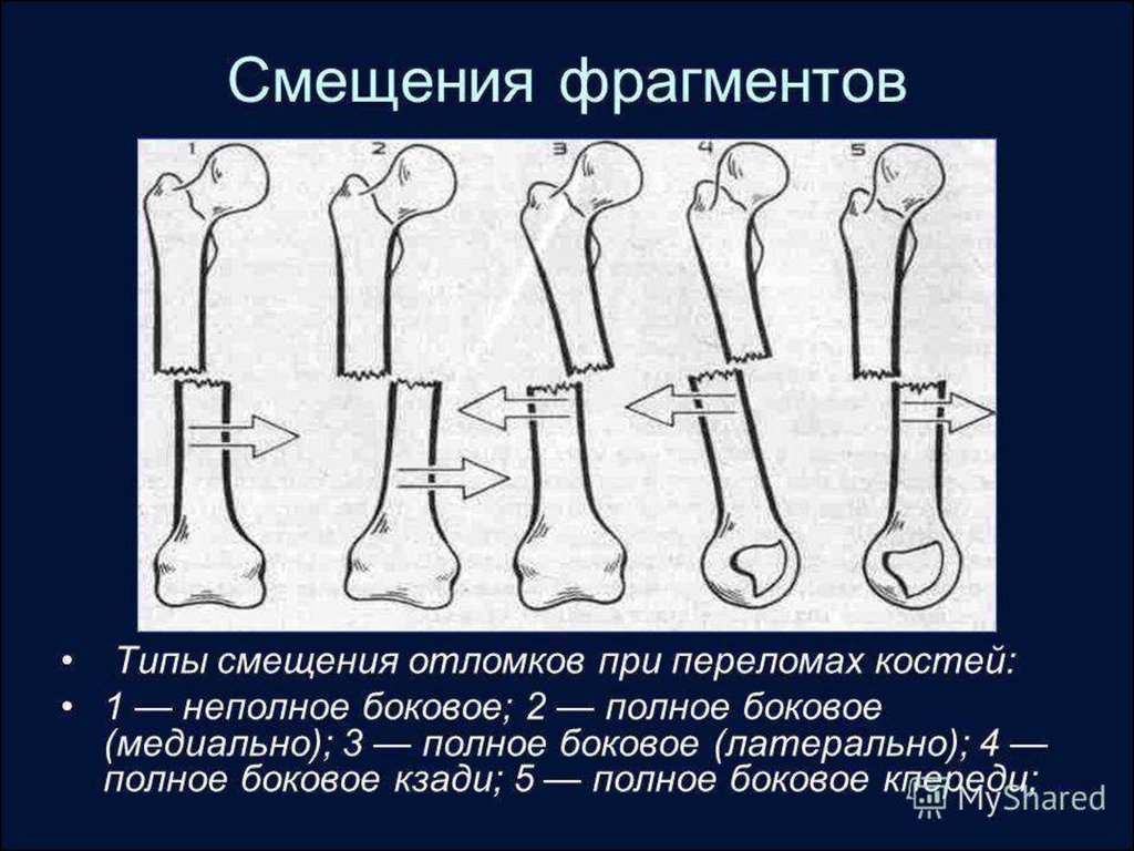 Смещение отломков кости. Степени смещения костных отломков. Смещение костных отломков по ширине. Виды смещения отломков при переломах костей. Классификация смещений костных отломков.