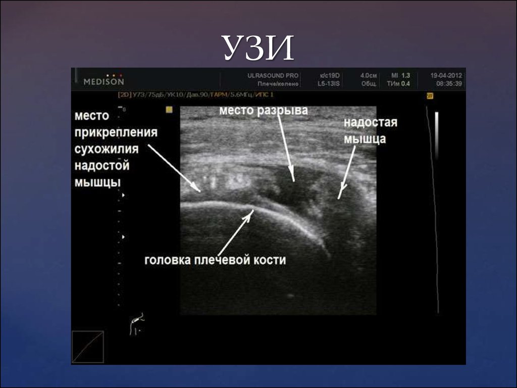 Видное сделать узи. УЗИ плечевого сустава норма. Повреждения сухожилий УЗИ. УЗИ плечевого сустава, протоколы, методика.