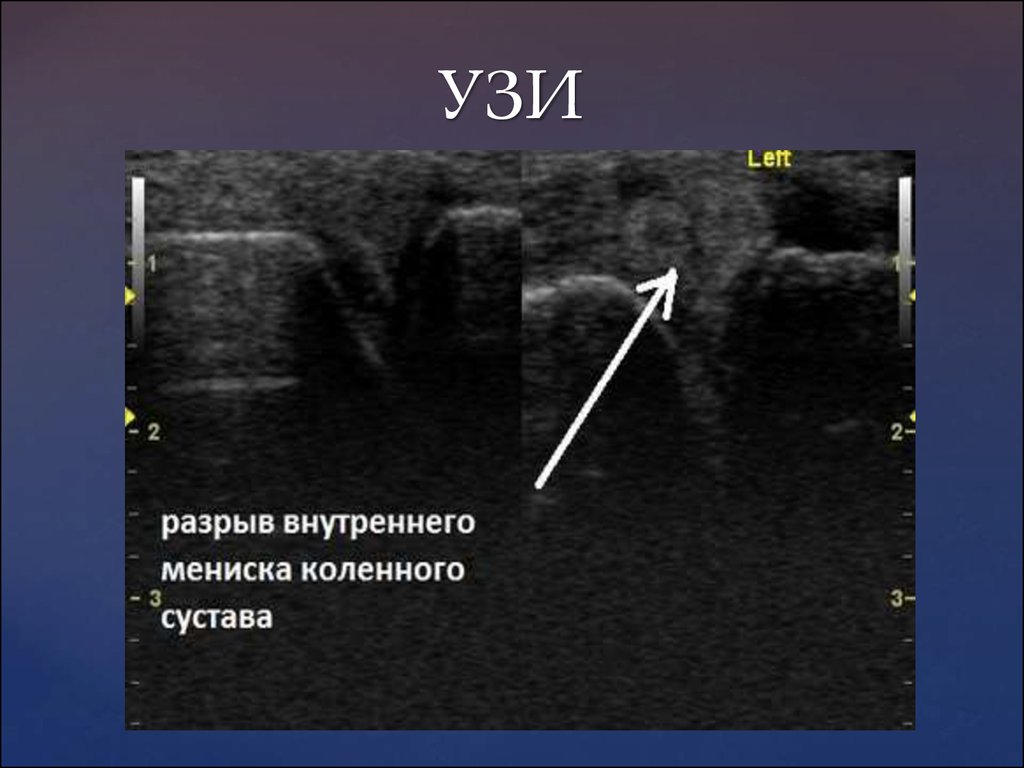 Узи сочленения. Разрыв мениска коленного сустава на УЗИ. Разрыв связок коленного сустава УЗИ. Повреждение менисков на УЗИ. Повреждение мениска коленного сустава УЗИ.