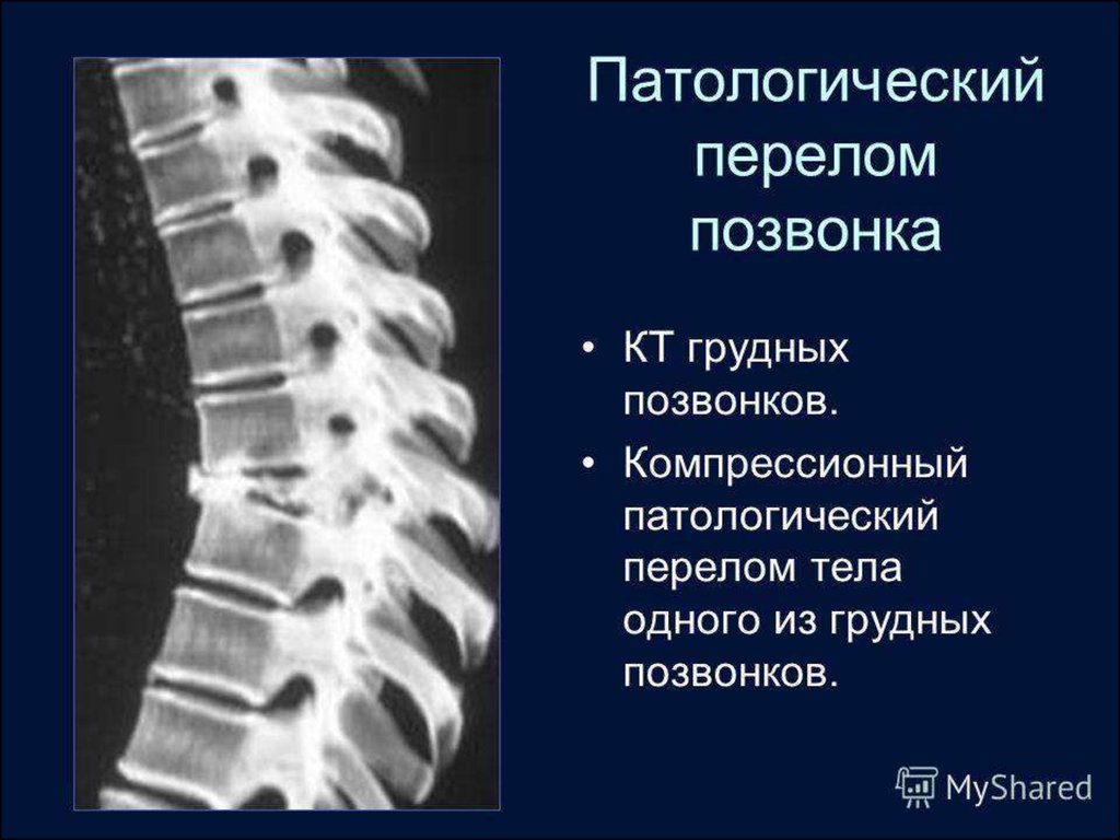 Компрессионный перелом тела 1 1. Компрессионный перелом позвоночника th5. Компрессионный перелом позвоночника th-5-6. Компрессионный перелом l1 th12. Компрессионный перелом грудного позвонка рентген.