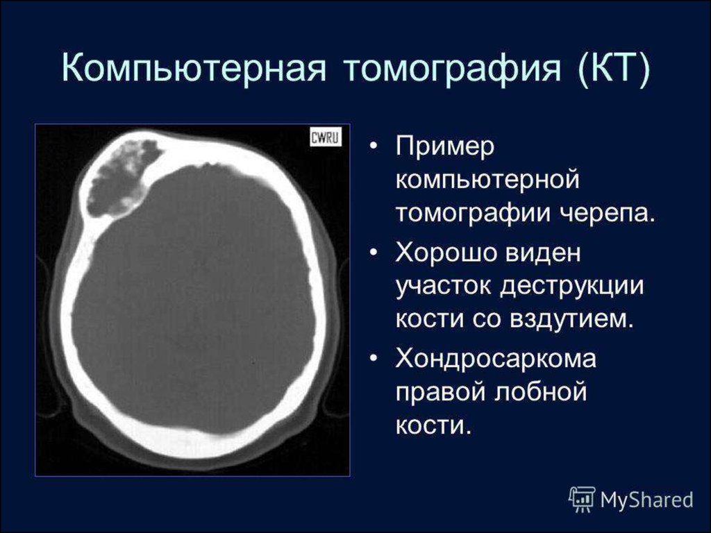 Образование кости черепа