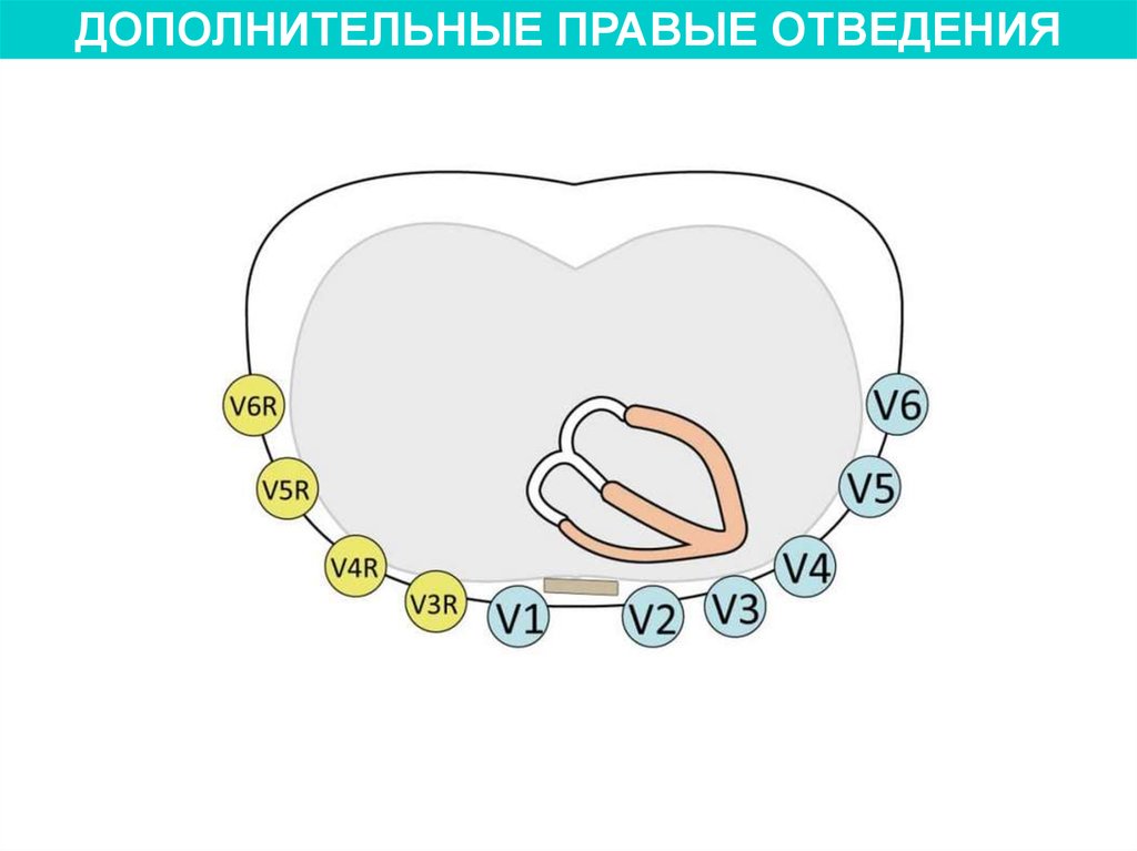 Правые отведения. Отведения v3r-v6r. Дополнительные отведения v3r-v5r. Доп отведения v7 v9. Отведения v3r v4 дополнительные.