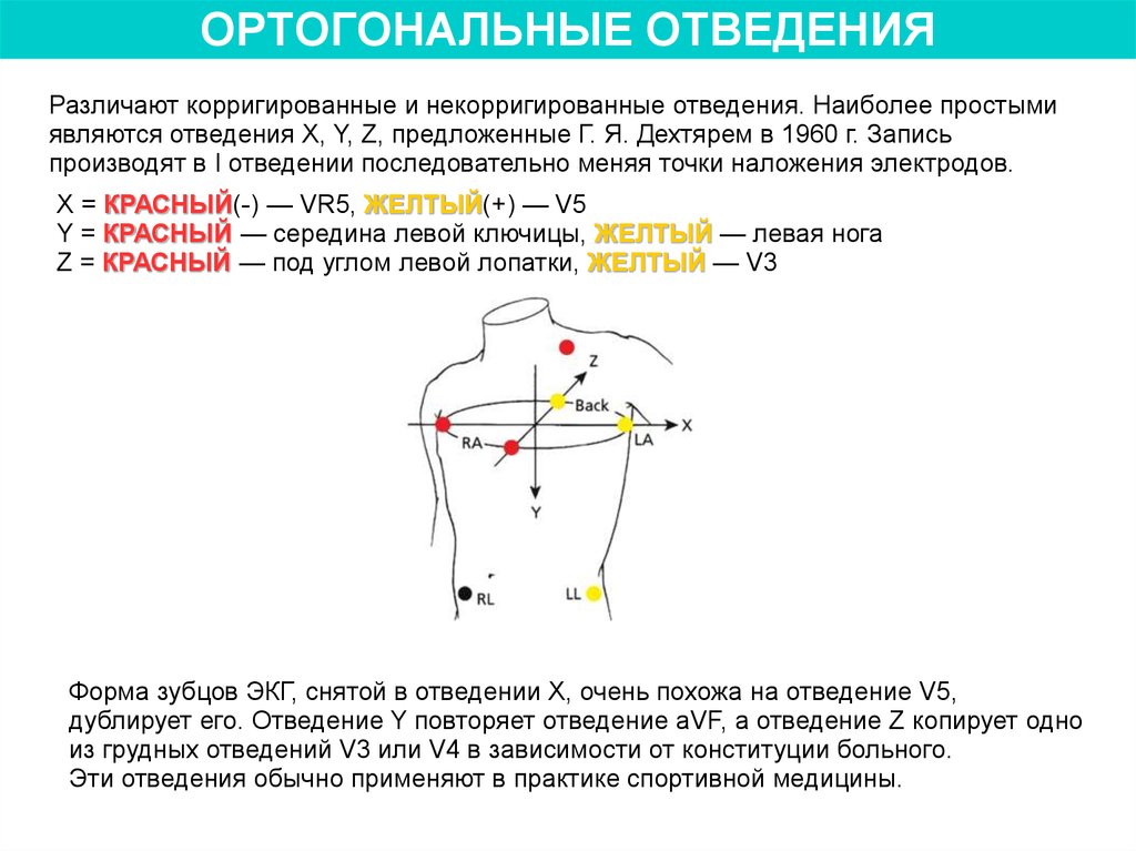 Схема наложения электродов при холтеровском мониторировании 3 канала