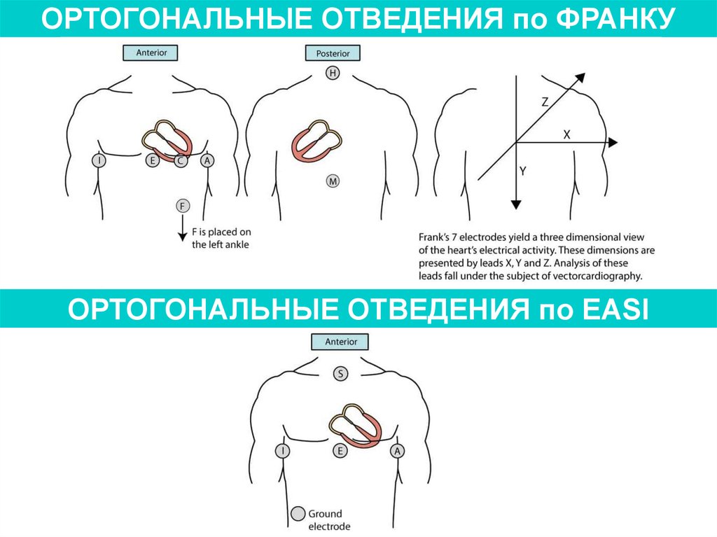 Экг по лиану расположение электродов фото