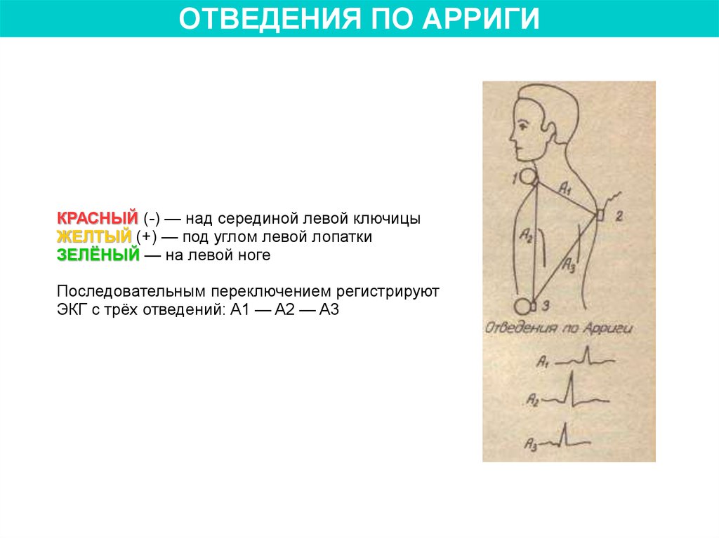 Левые отведения. 3 Отведение на ЭКГ. 1 Отведение. Левые отведения ЭКГ. 1 Отведение ЭКГ.