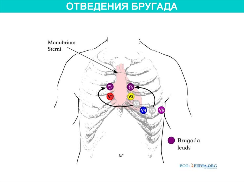 Экг по лиану расположение электродов фото