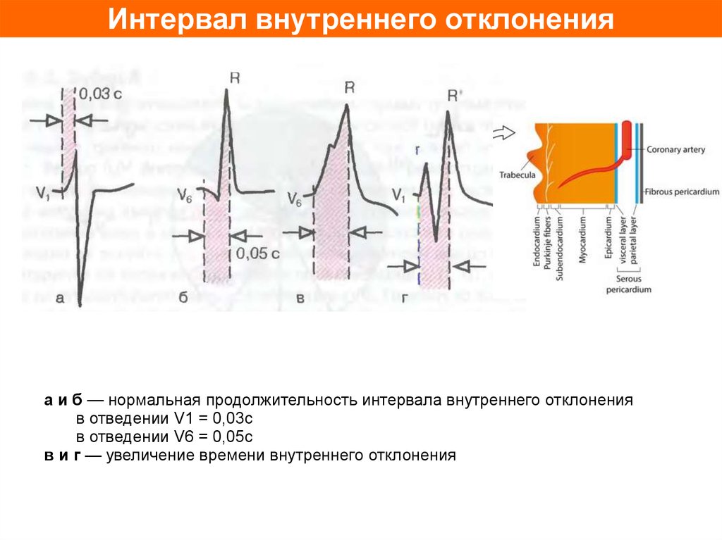 Смещение параметров qrs