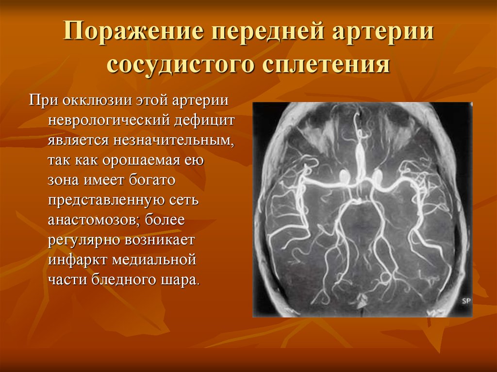 Окклюзия артерии мозга. Сосудистое сплетение. Переднюю артерию сосудистого сплетения. Передняя артерия сосудистого сплетения анатомия. Передней хориоидальной артерии.