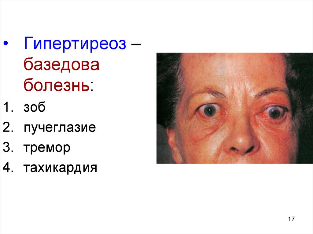 Базедова болезнь что это такое. Клинические симптомы базедовой болезни. Базедова болезнь патогенез симптомов. Гормоны щитовидной железы базедова болезнь. Тиреотоксикоз (базедова болезнь).