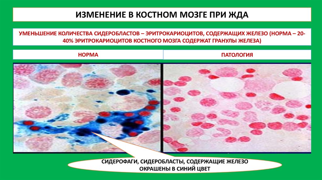 Картина периферической крови при железодефицитной анемии