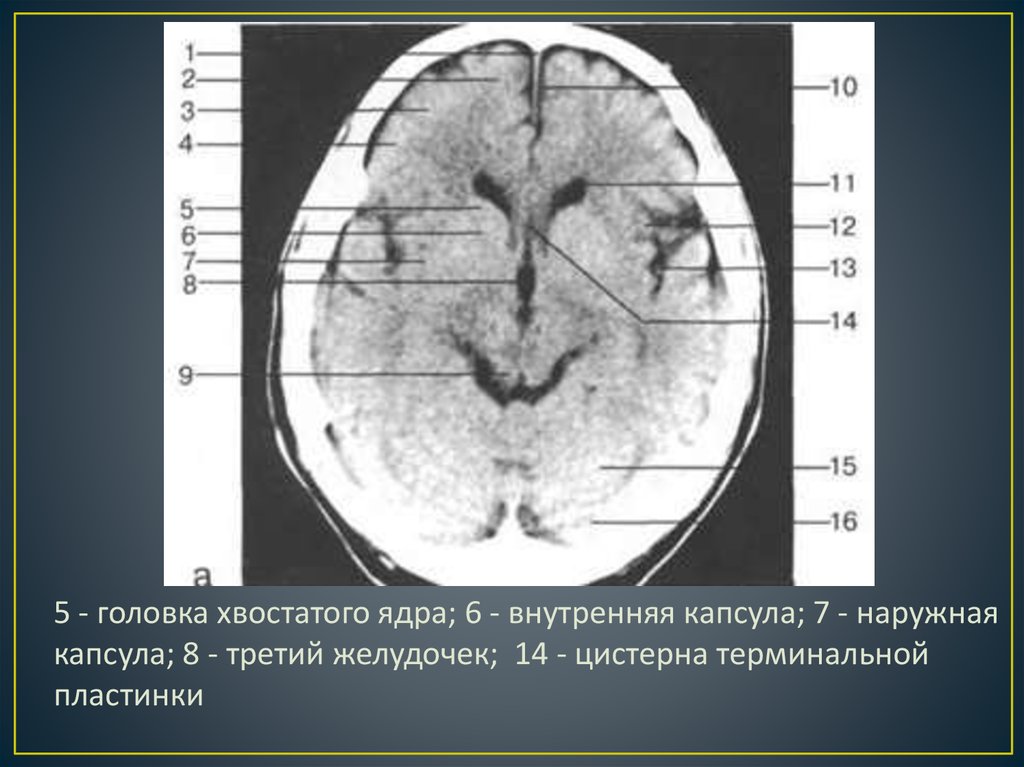 Базальные ядра головного мозга фото