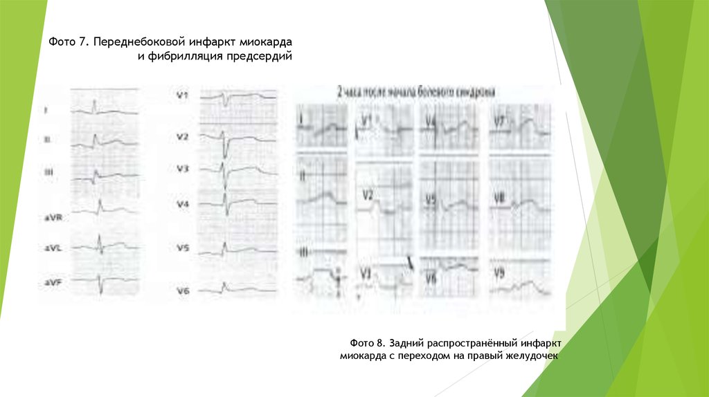 Изменения миокарда предсердий. Переднебоковой инфаркт миокарда на ЭКГ. Инфаркт миокарда переднебоковой стенки. ЭКГ инфаркт миокарда переднебоковой стенки. Инфаркт миокарда переднебоковой стенки левого желудочка.