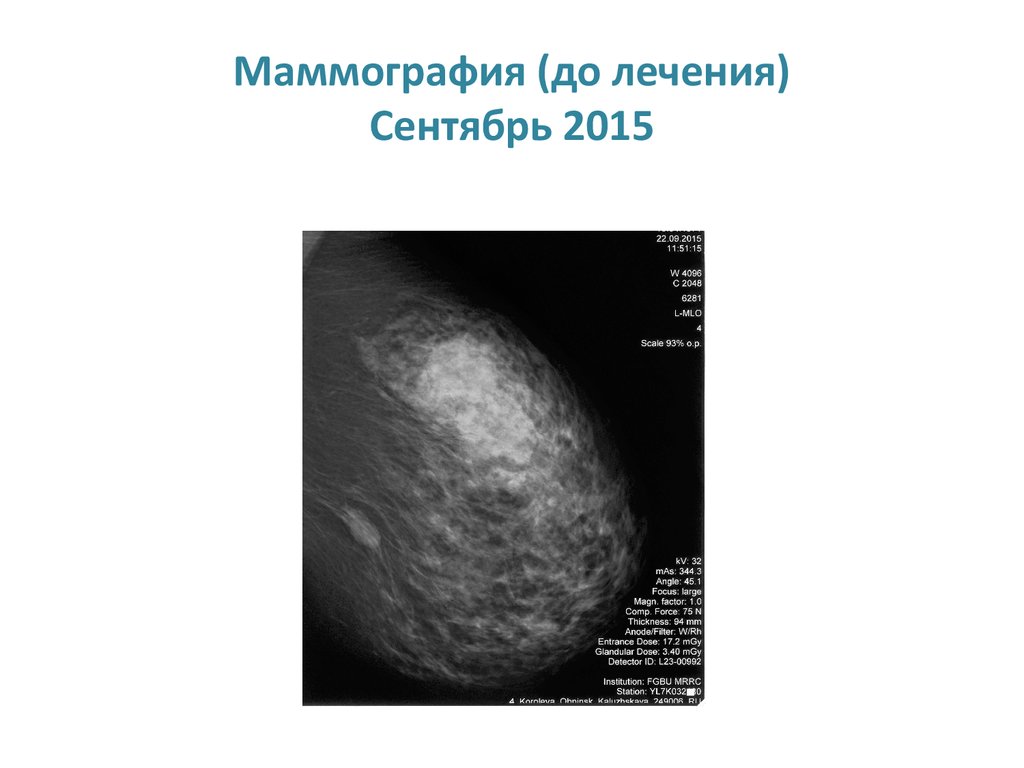 Категории маммографии. Маммография. Маммография презентация. Снимки маммографии молочных желез.