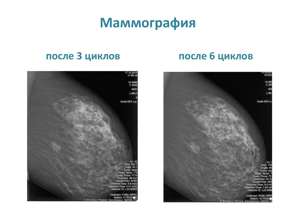 Результаты маммографии