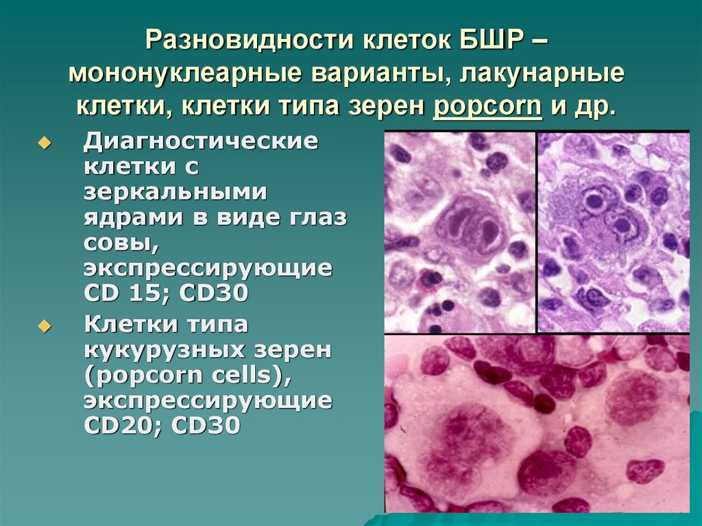 Лимфома ходжкина типы. Клетки Ходжкина гистология. Клетки Ходжкина патанатомия. Лимфома Ходжкина микропрепарат патанатомия.