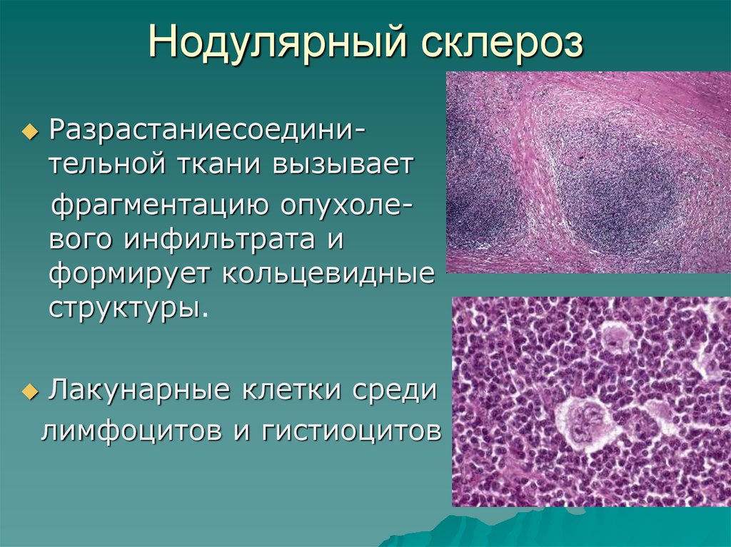 Злокачественными новообразованиями лимфоидной. Клетки Ходжкина гистология. Лимфогранулематоз нодулярный склероз микропрепарат. Лимфома Ходжкина гистология. Ходжкинская лимфома микропрепарат.