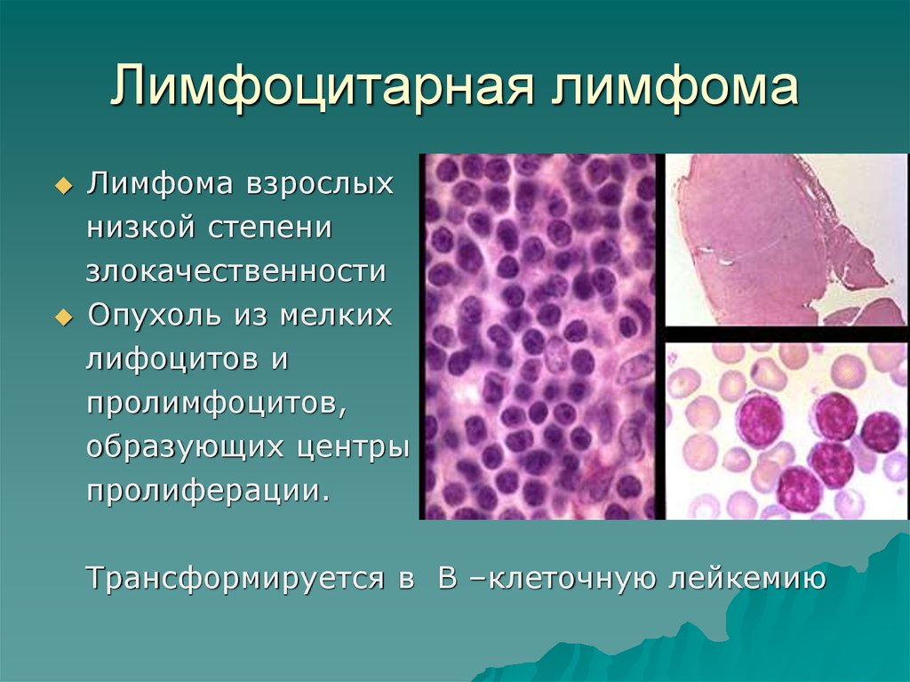 Новообразование лимфоидной ткани. Клеточная (неходжкинская) лимфома кожи. Крупноклеточная лимфома патанатомия. Неходжкинская лимфома гистология.