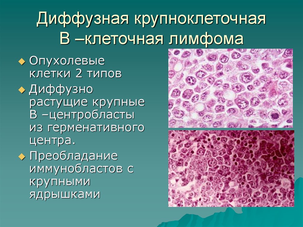 Диффузная крупноклеточная в клеточная. Клетки Ходжкина гистология. Диффузная б клеточная лимфома. B клеточная лимфома микропрепарат. Диффузная в-крупноклеточная лимфома микропрепарат.