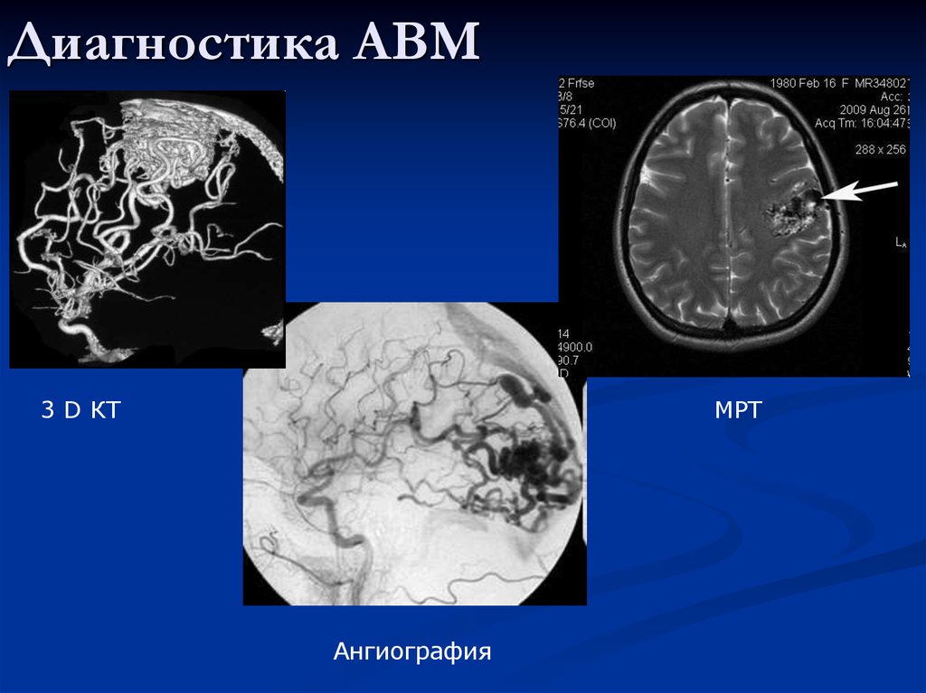 Венозная мальформация лобной доли. Артериальнаямальформации кт. АВМ на кт головного.