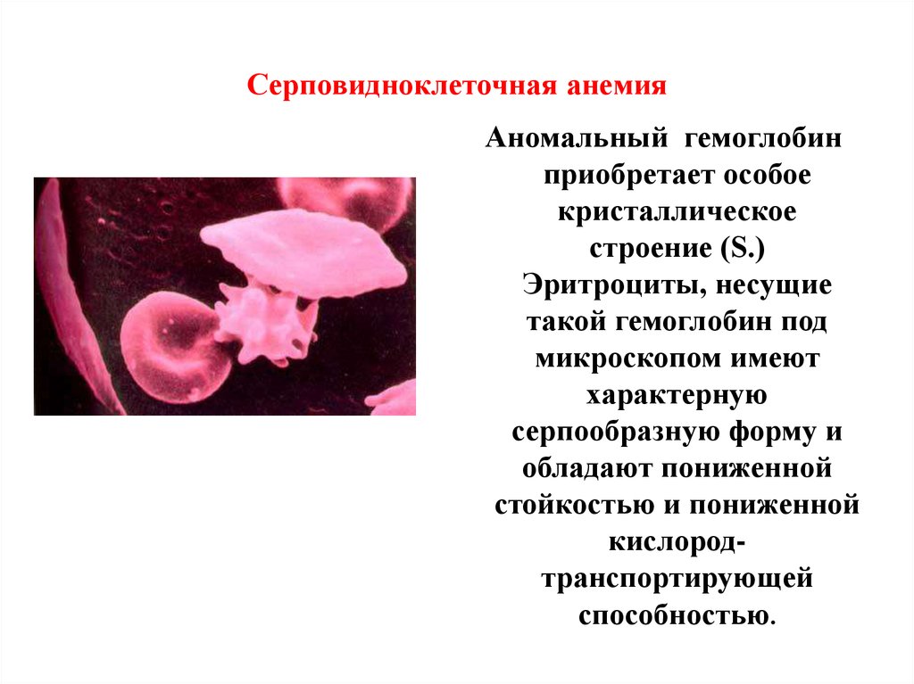 Приобретает особый. Серповидноклеточная анемия Тип наследования. Гемоглобин серповидноклеточная анемия. Гемоглобин при серповидноклеточной анемии. Причины серповидноклеточной анемии биохимия.