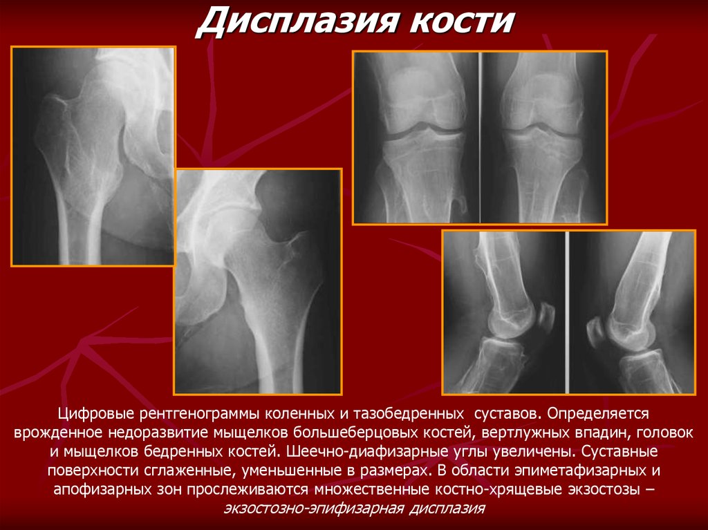 Дисплазия это. Фиброзная дисплазия коленного сустава рентген. Дисплазия блока коленного сустава. Эпифизарная дисплазия бедренной кости. Костно- хрящевая дисплазии.