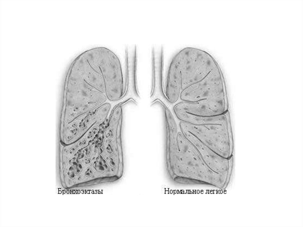 Бронхоэктатическая болезнь рисунки