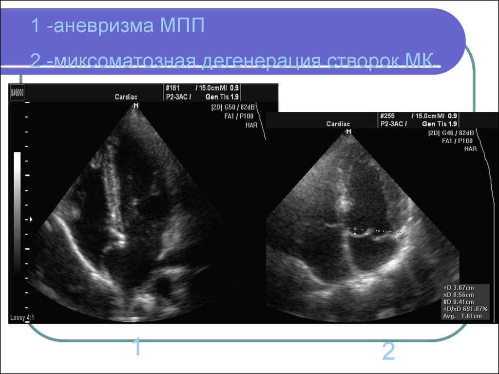 Аневризма мпп. Эхокардиография аневризма МПП. Аневризма МПП на ЭХОКГ. Межпредсердная перегородка аневризма. Аневризма левого предсердия МПП.