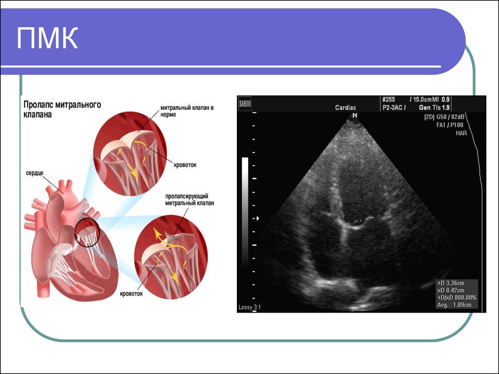 Заболевание пролапс митрального клапана. Что такое пролапс митрального клапана сердца 1 степени. Пролапс митрального клапана симптомы ЭХОКГ. Пролапс митрального клапана ЭХОКГ классификация. Пролапс трикуспидального клапана 1-2 степени.