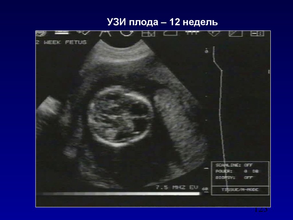 Ребенок 11 недель узи. УЗИ 12 недель. УЗИ 12 недель беременности. Снимки УЗИ на 12 неделе. Снимок УЗИ на 12 неделе.