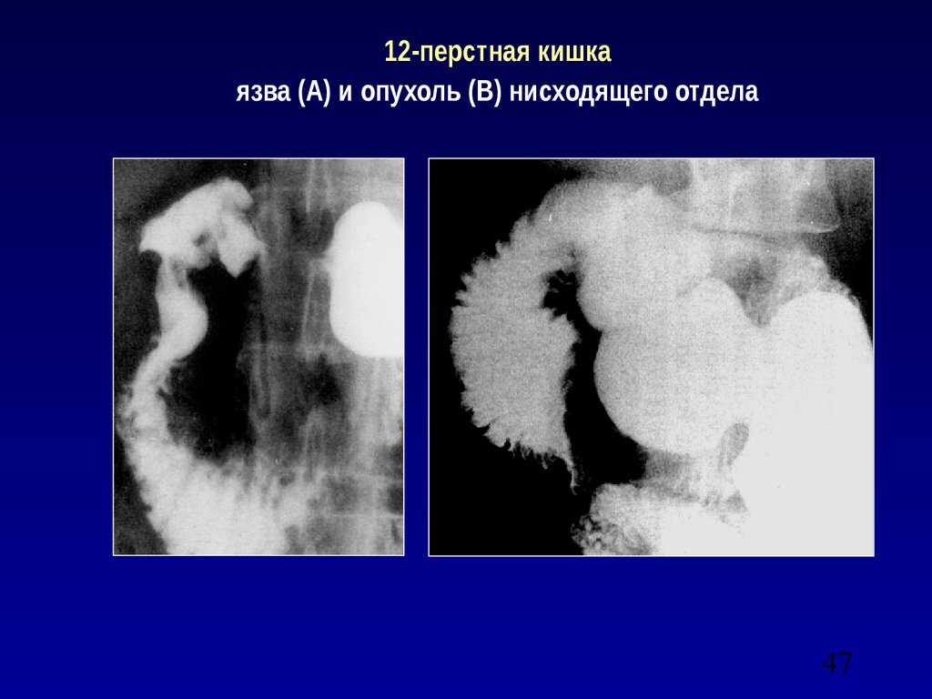 12 перстная кишка диагнозы. Прободная язва желудка рентген. Язва ДПК рентгенография. Рентгеновские снимки язвы 12-перстной кишки. Язва ДПК рентгеноскопия.