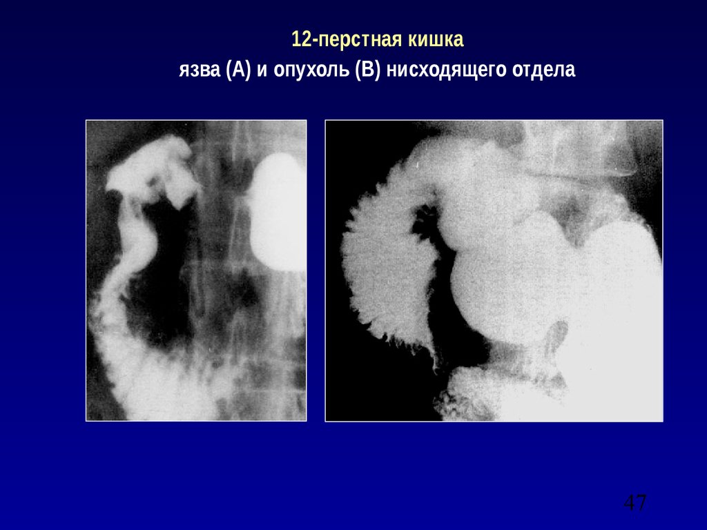 12 кишка болезни. Язвенная болезнь желудка и 12 перстной кишки рентген. Язвенная болезнь ДПК рентген. Язвенная болезнь 12 перстной кишки рентген. Рентген желудка и 12-перстной кишки при язве.