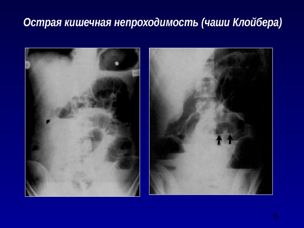 Острая кишечная непроходимость. Острая кишечная непроходимость рентгенография. Рентген кишечника чаши Клойбера. Острая кишечная непроходимости ренг. Острая кишечная непроходимость чаши Клойбера.