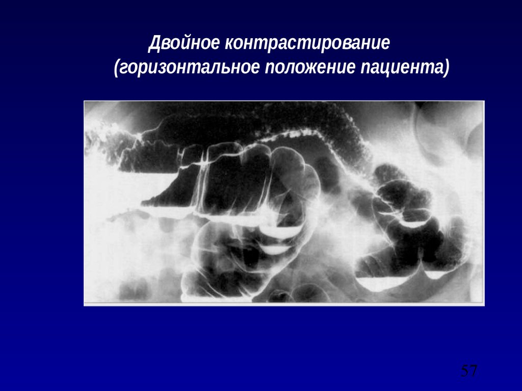 Ирригоскопия это рентгенологическое контрастное исследование. Рентгенологическое исследование Толстого кишечника (ирригоскопия).. Двойное контрастирование. При ирригоскопии исследуемый орган:. Ирригоскопия с двойным контрастированием.