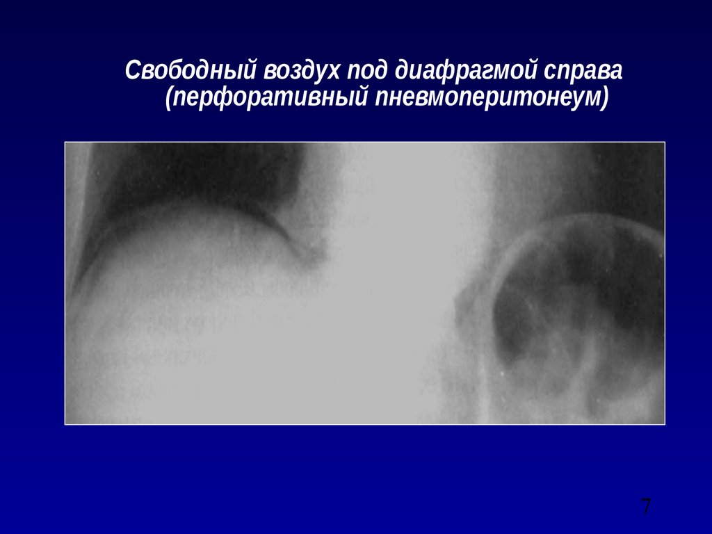 Под диафрагмой. Воздух под диафрагмой. Воздух под диафрагмой справа. Воздух под диафрагмой на рентгене. Воздух в брюшной полости.