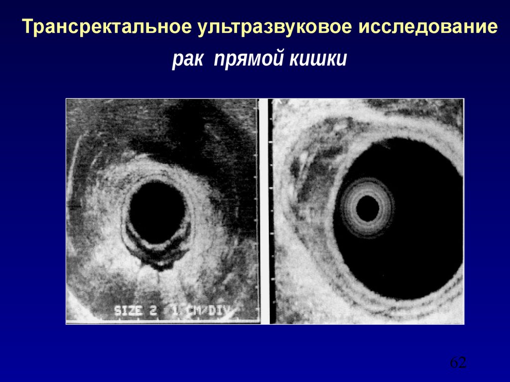 Узи кишки. Трансректальное УЗИ прямой кишки. Ультразвуковое исследование прямой кишки трансректальное. Ультрасонография прямой кишки. Исследование прямой кишки трансректальное.