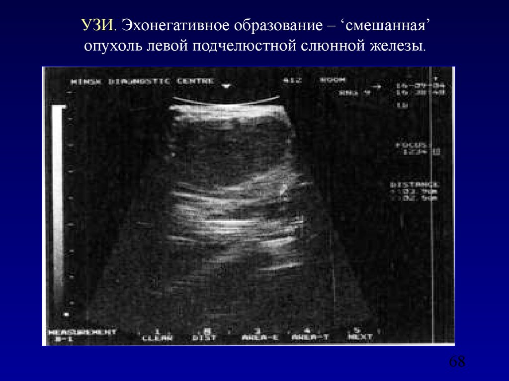 Узи слюнных. Слюнные железы патология на УЗИ. Слюнные железы УЗИ исследование. Образование слюнной железы УЗИ. Опухоль слюнной железы на УЗИ.