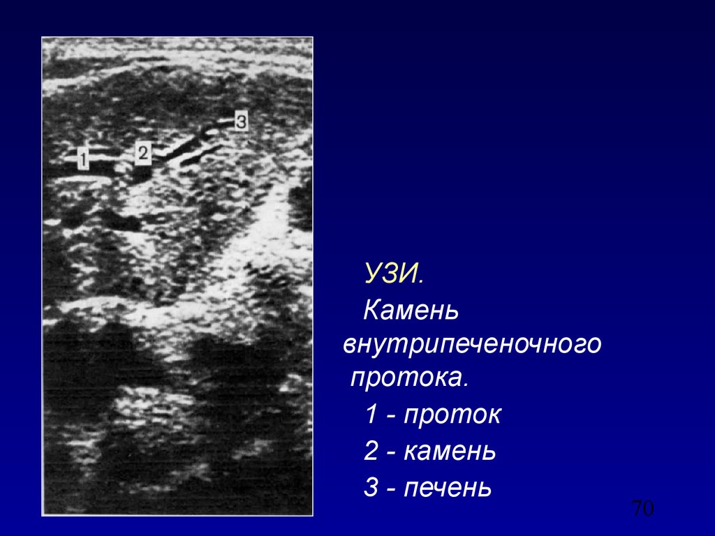 Расширение протоков печени. Камень в печеночном протоке. Внутрипеченочные протоки на УЗИ. Конкременты печеночных протоков.