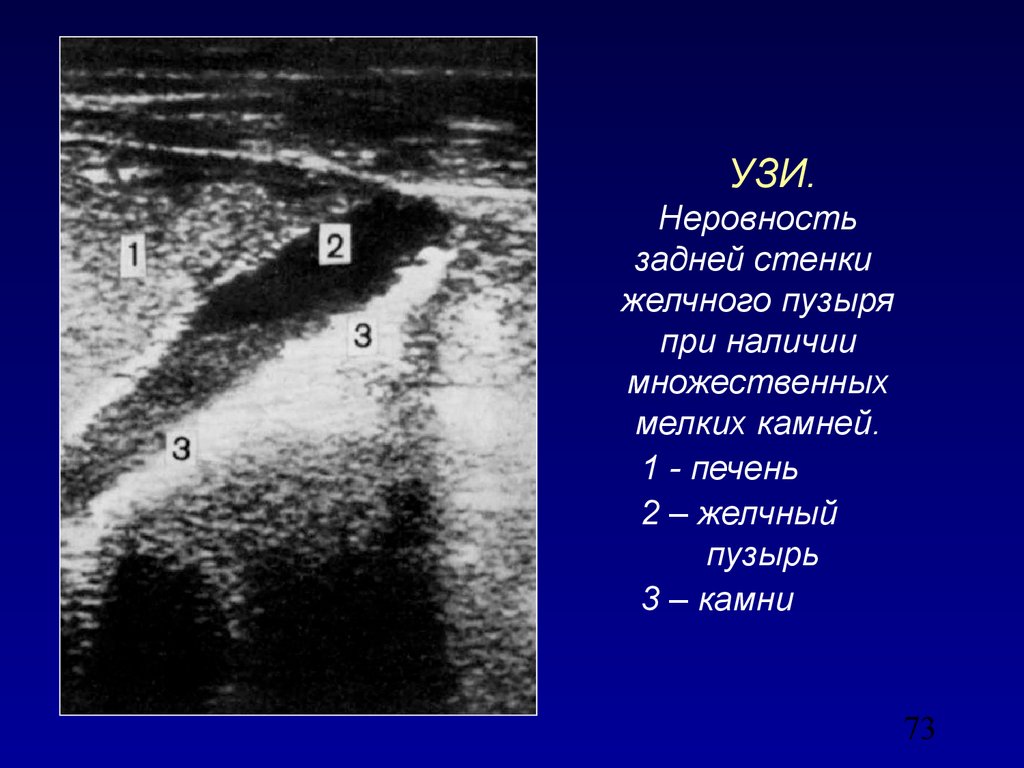 Узи стенок. Описание камней в желчном пузыре на УЗИ. Норма стенки желчного пузыря при УЗИ. Стенки желчного пузыря на УЗИ. Задняя стенка желчного пузыря по УЗИ.