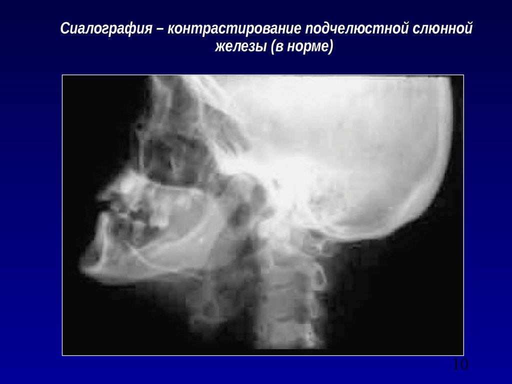 Лучевая диагностика заболеваний слюнных желез презентация