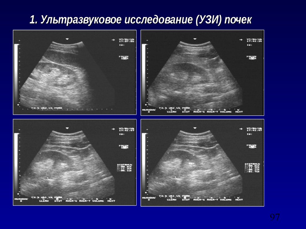 Поликистоз почек на узи. УЗИ признаки поликистоза почек. УЗИ критерий поликистоза почек. Поликистоз почек УЗИ картина.