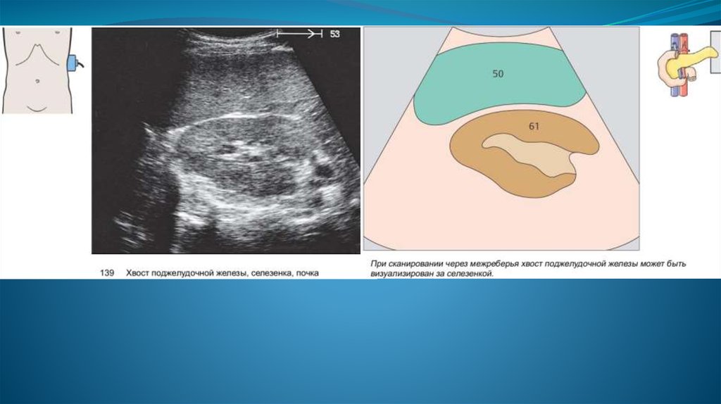 Размеры поджелудочной на узи. Ультразвуковое исследование поджелудочной железы. УЗИ поджелудочной железы. Темные пятна на поджелудочной железе на УЗИ. УЗИ поджелудочной железы подготовка к исследованию.