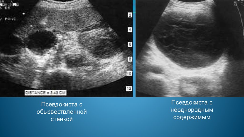 Псевдокиста поджелудочной железы на УЗИ. Псевдокиста поджелудочной кт. УЗИ признаки псевдокисты. Псевдокиста селезенки кт.